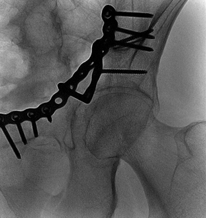 Intraoperatives Röntgenbild